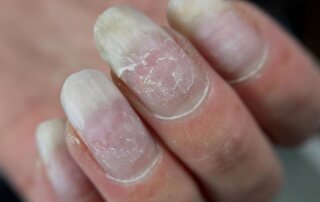 Why Are My Nails Peeling